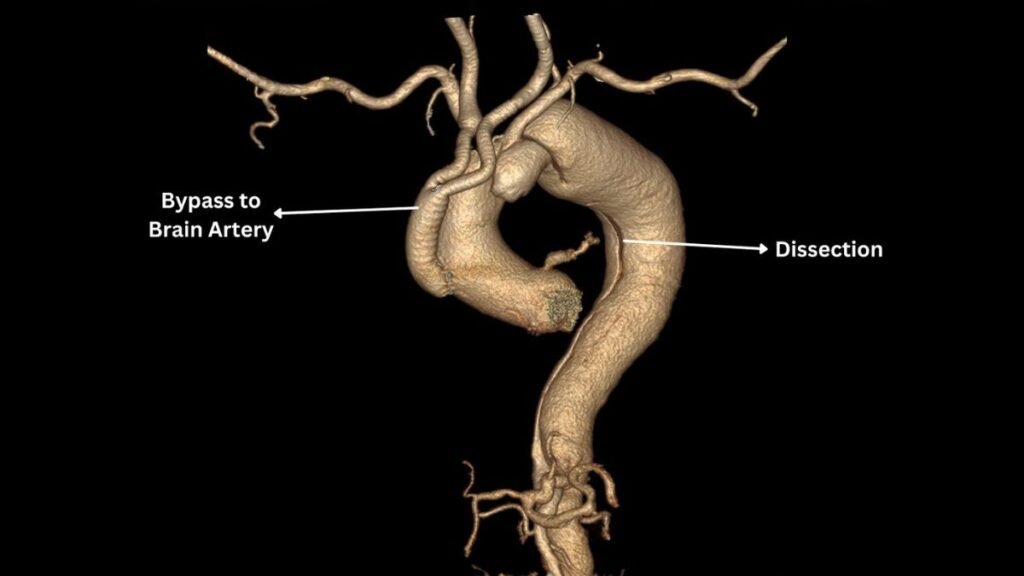 Medical Marvel at SSB Heart and Multispeciality Hospital: Pioneering Hybrid Procedure Saves a Life - PNN Digital Medical Marvel at SSB Heart and Multispeciality Hospital: Pioneering Hybrid Procedure Saves a Life - PNN Digital
